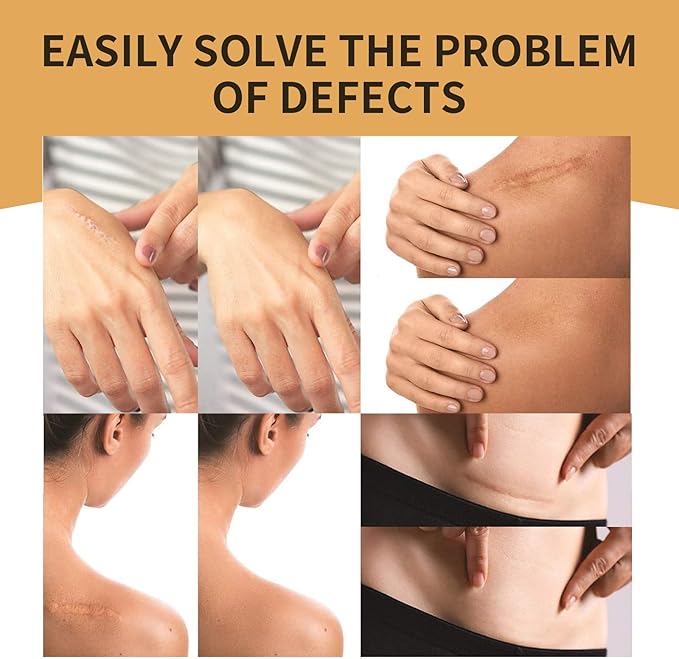 Tattoo Cover Up,Scar Cover Stickers Tape,Waterproof Ultra Thin Patch Pads Concealer Body Leg Bruise Stretch Scar Dark Spots Vitiligo Skin Makeup,Long Lasting Invisible Tattoo Flaw Conceal Patch - 6PCS